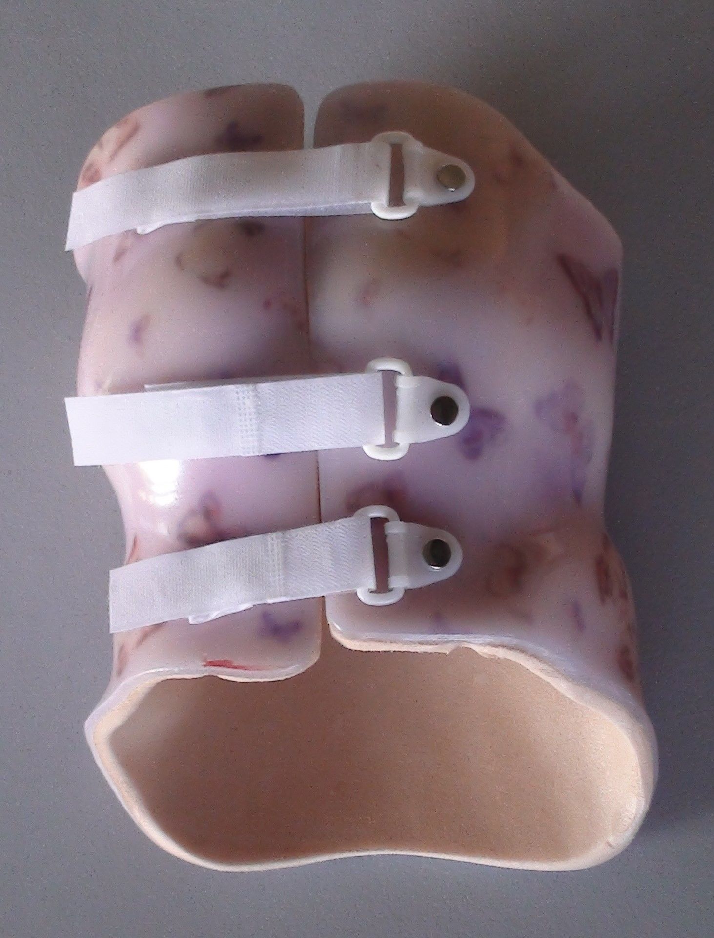A plaster cast